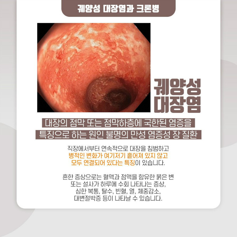 [소화기내과] 염증성장질환 3.jpg